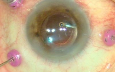 Chirurgia vitreo-retinica mini invasiva