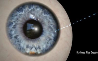 Z-LASIK: la LASIK con il laser a femtosecondi Ziemer