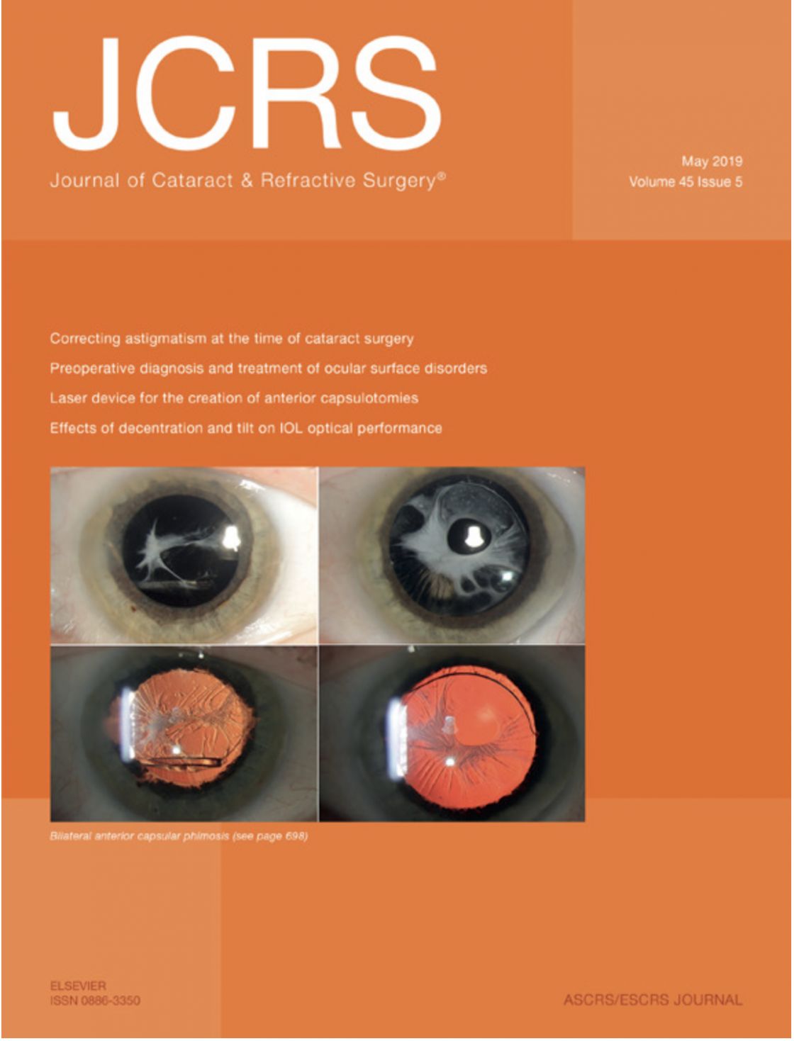 Measurement of central corneal thickness with optical low-coherence reflectometry and ultrasound pachymetry in normal and post-femtosecond laser in situ keratomileusis eyes