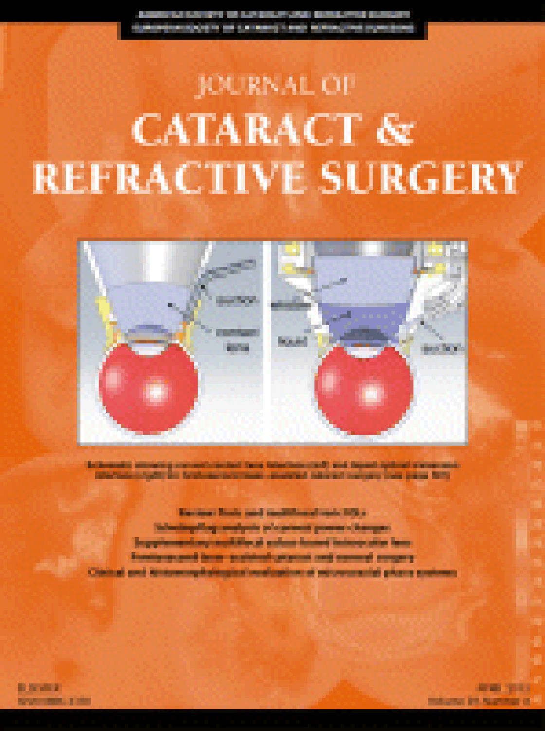 Comparison of methods to measure corneal power for intraocular lens power calculation using a rotating Scheimpflug camera