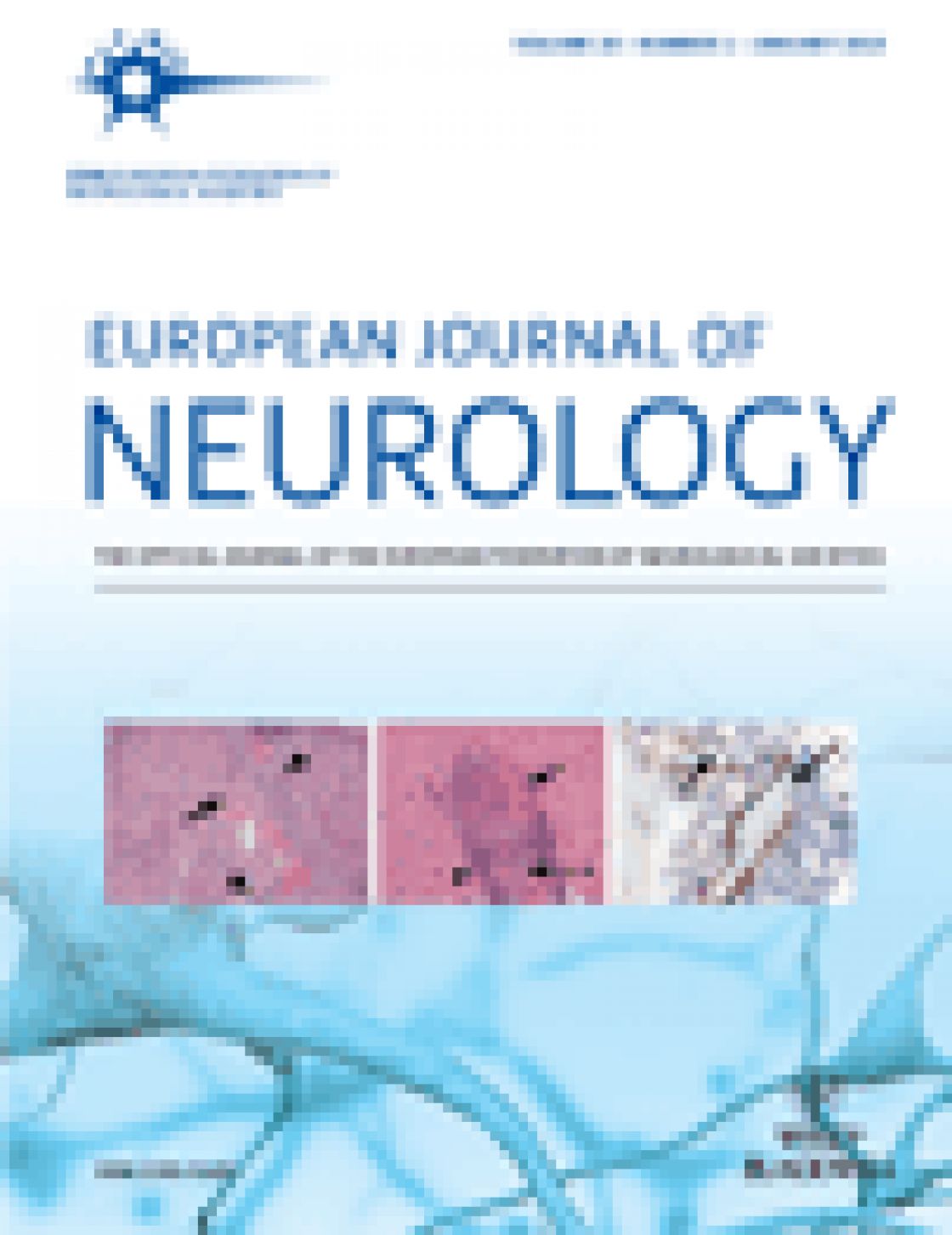 Loss of temporal retinal nerve fibers in Parkinson disease: a mitochondrial pattern?