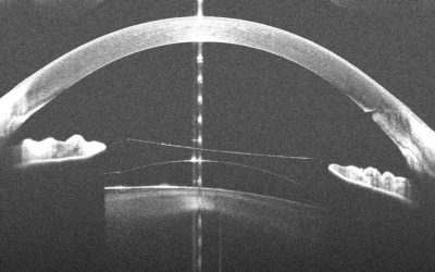 ICL: un nuovo standard per la chirurgia refrattiva