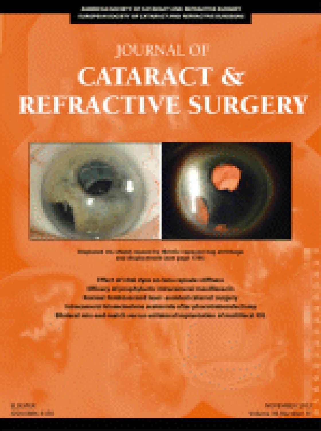 Surgical management of malignant glaucoma with white cataract in nanophthalmos