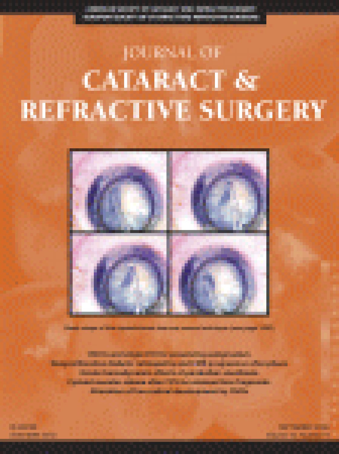 Corneal melting associated with topical diclofenac use after laser-assisted subepithelial keratectomy.