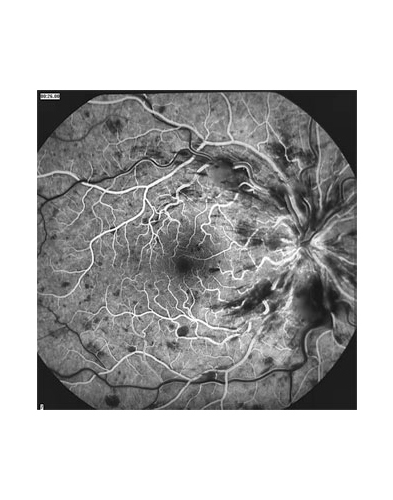 eyedisease-central_retinal_vein_occlusion-3