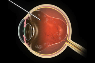 Injection_vitreous-cavity